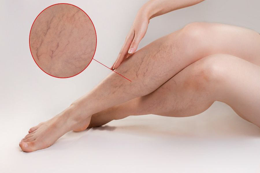 Varicose Veins